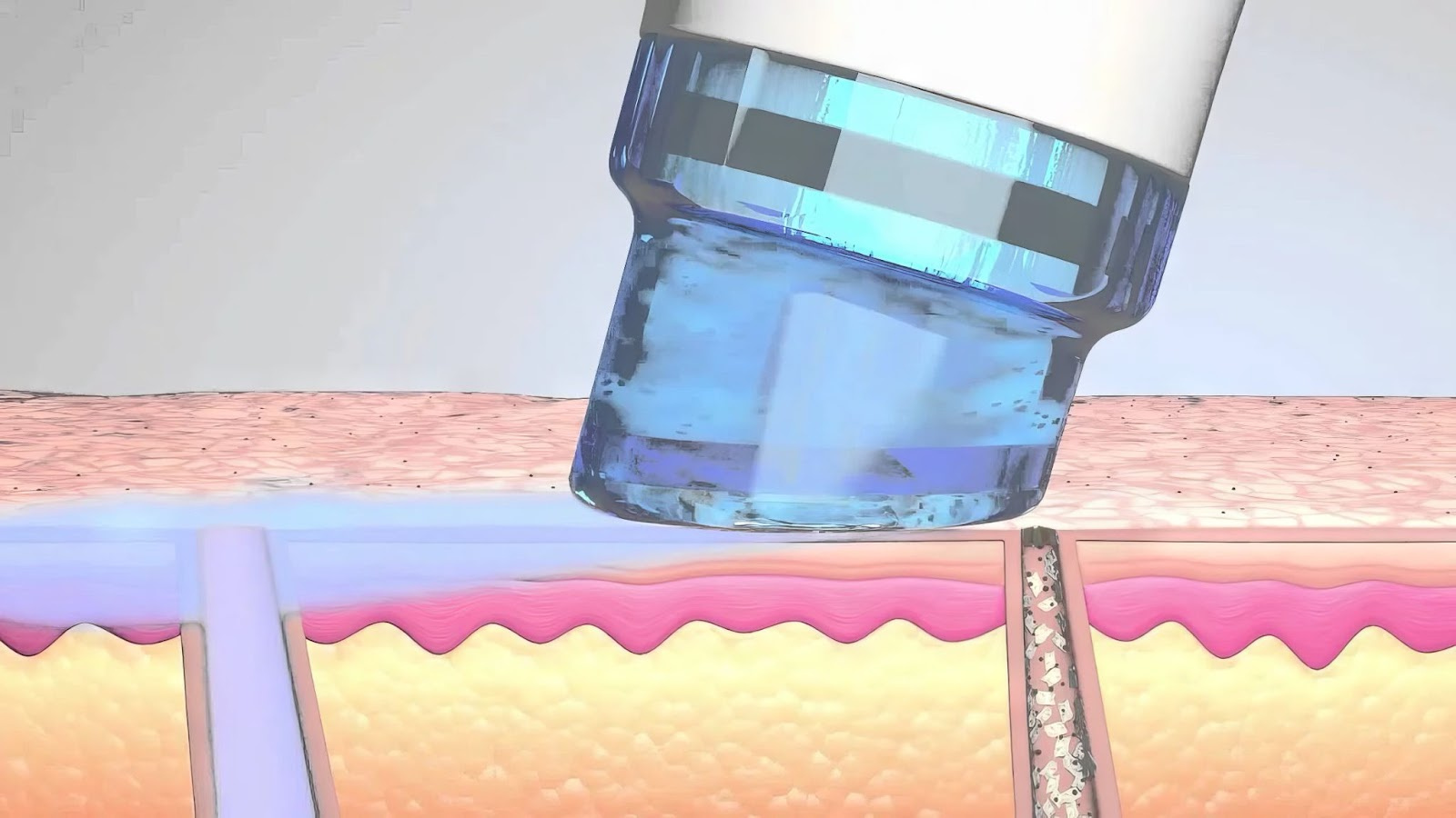 Фото: Hydrofacial вблизи; очищение пор