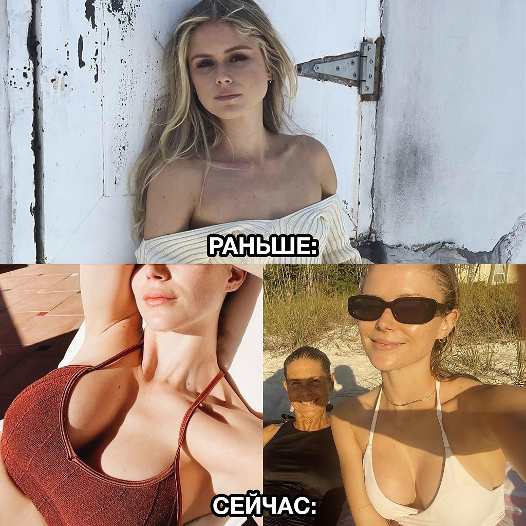 До и после увеличения груди