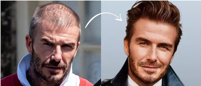 До и после пересадки волос