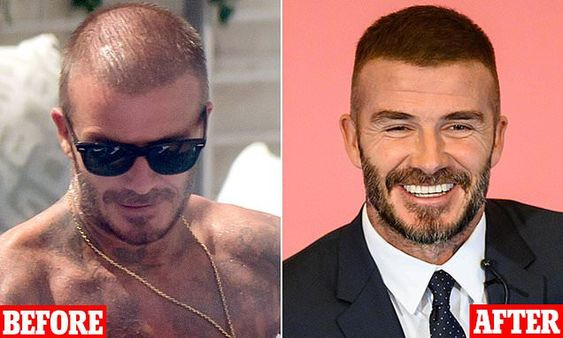 До и после пересадки волос