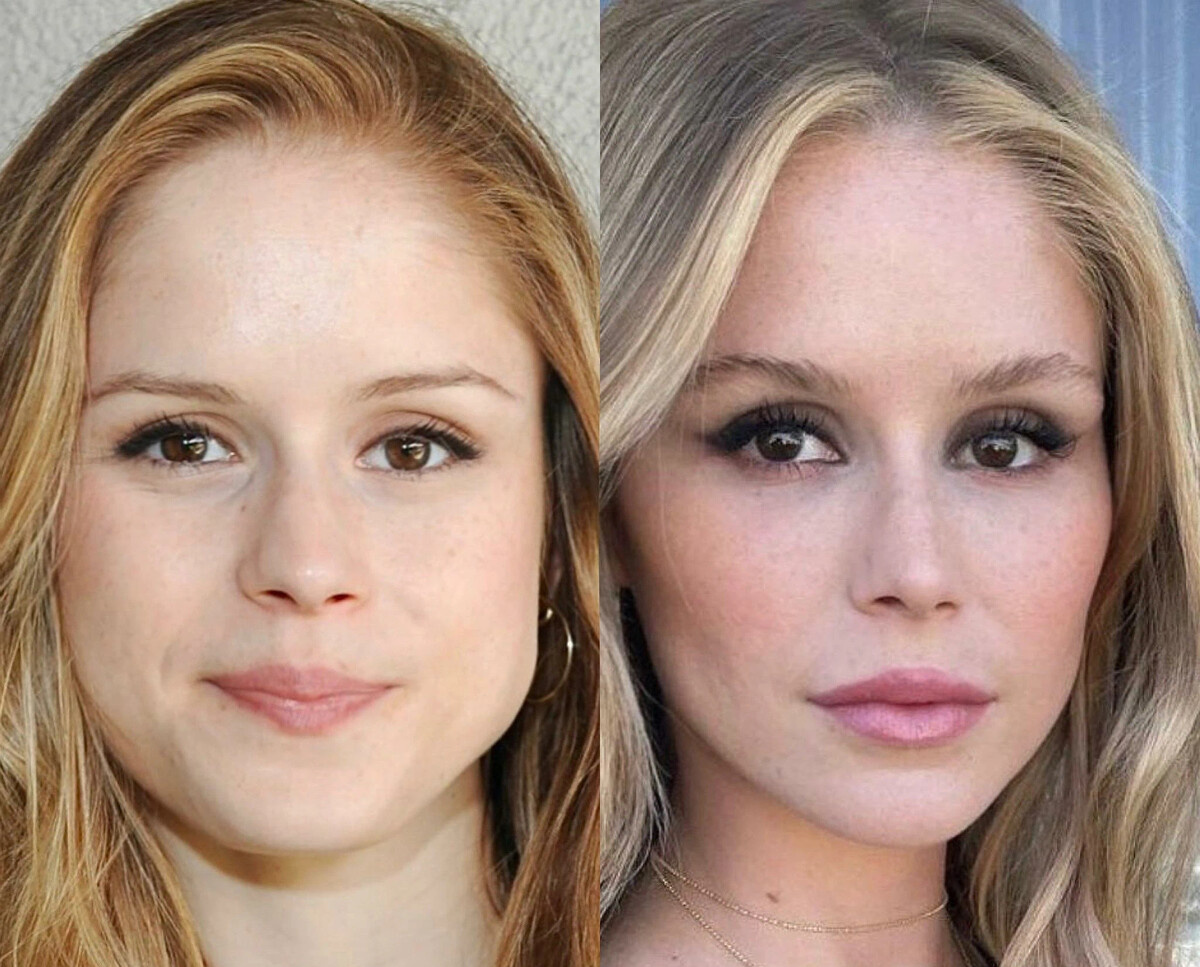 До и после коррекции челюсти