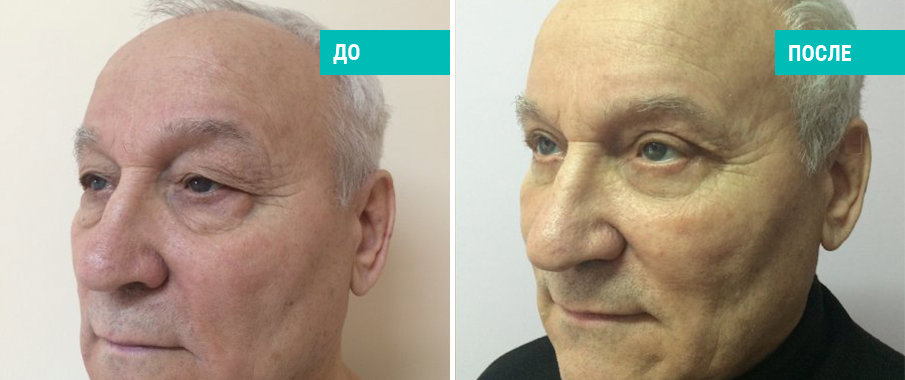 До и после блефаропластики. Пластический хирург О. А. Андрющенко