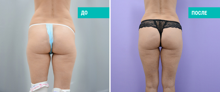До и после липосакции бедер. Пластический хирург О. Е. Бадак