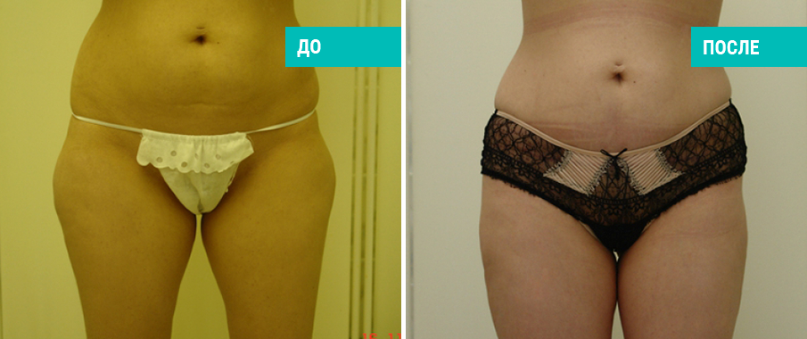 До и после липосакции боков. Пластический хирург Т. А. Иванченкова