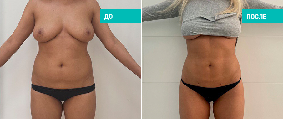 До и после липосакции живота и боков. Пластический хирург Н. Б. Иоселиани