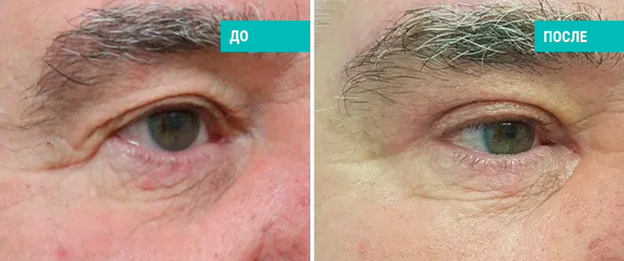 До и после блефаропластики. Пластический хирург В. Э. Кобазев