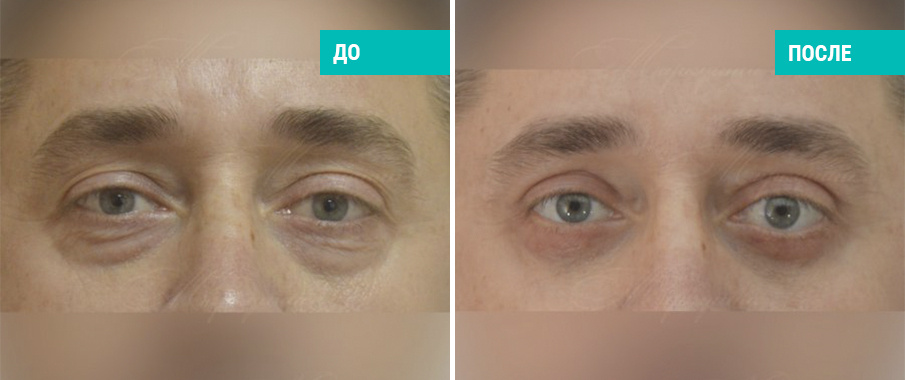 До и после блефаропластики. Пластический хирург А. А. Маркушин