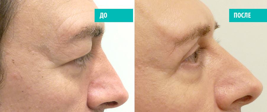 До и после блефаропластики. Пластический хирург В. А. Зленко