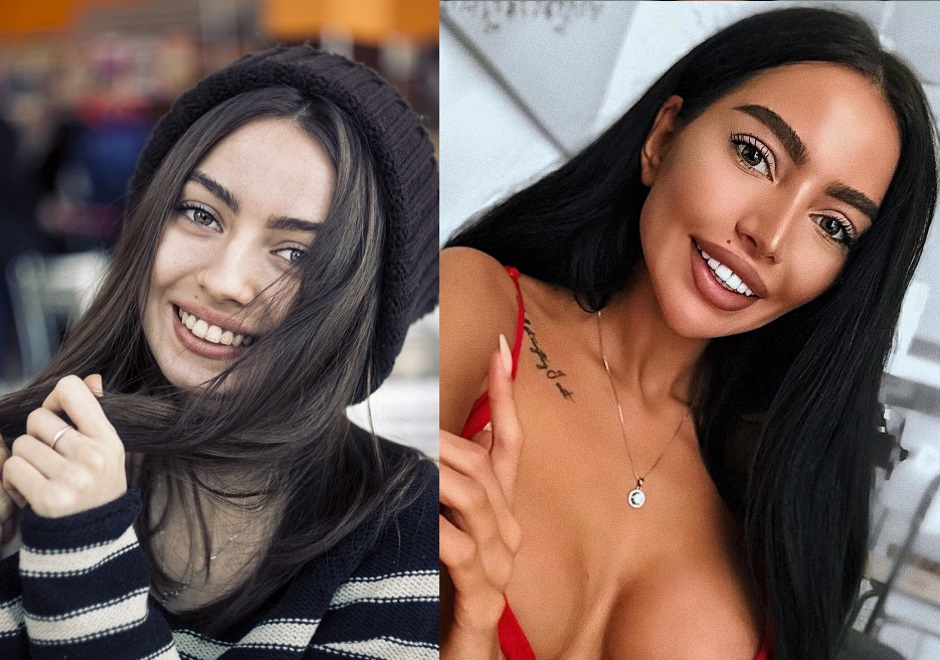 Алена Омович до и после ринопластики