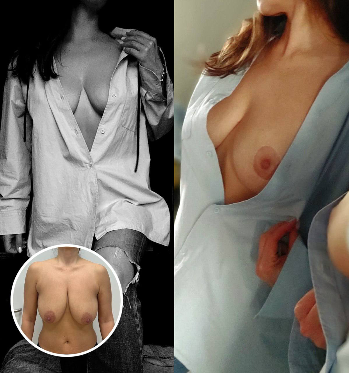 Уменьшение груди. Пациентка Н. Б. Иоселиани