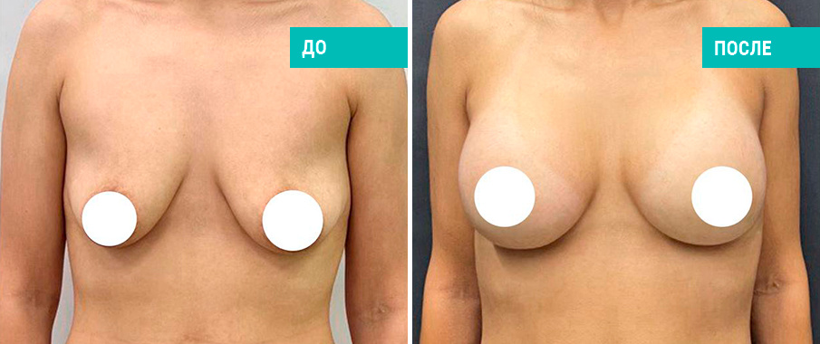 До и после одновременного увеличения имплантами с подтяжкой. Пациентка Н. Б. Иоселиани