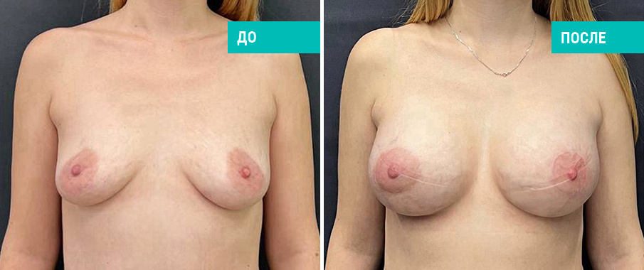 До и после одновременного увеличения имплантами с подтяжкой. Пациентка Н. Б. Иоселиани