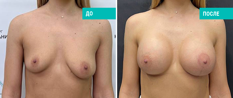 До и после одновременного увеличения имплантами с подтяжкой. Пациентка Н. Б. Иоселиани