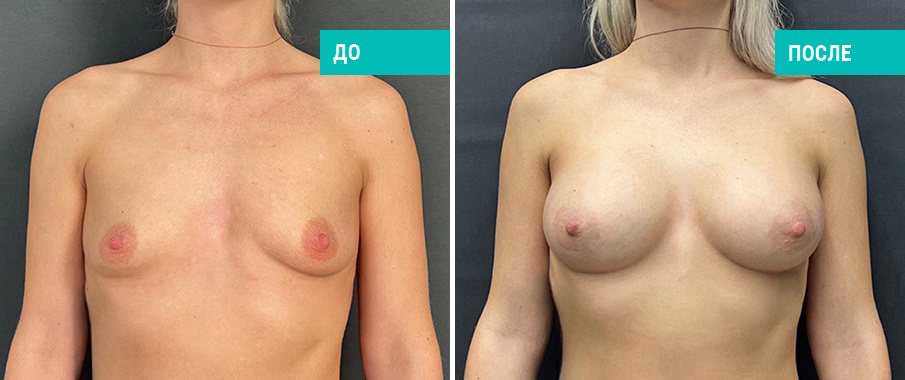 До и после одновременного увеличения имплантами с подтяжкой. Пациентка Н. Б. Иоселиани