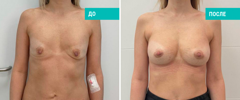 Фото до и после установки имплантов. Пациентка Н. Б. Иоселиани