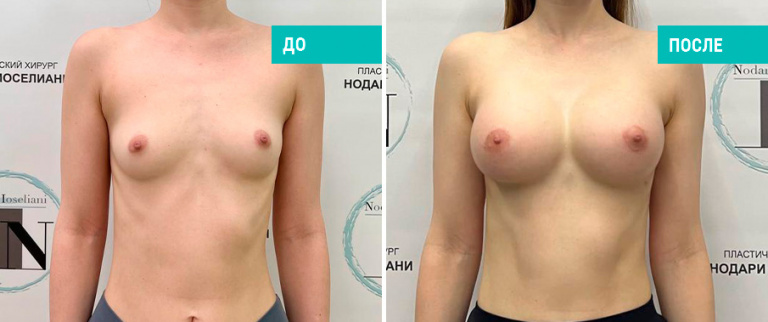 Фото до и после установки имплантов. Пациентка Н. Б. Иоселиани