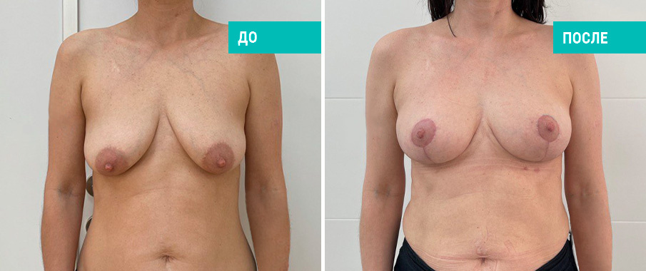 Фото до и после подтяжки груди. Пациентка Н. Б. Иоселиани