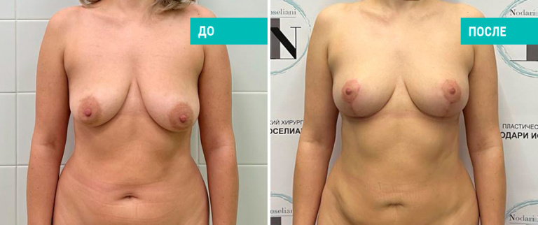Фото до и после подтяжки груди. Пациентка Н. Б. Иоселиани