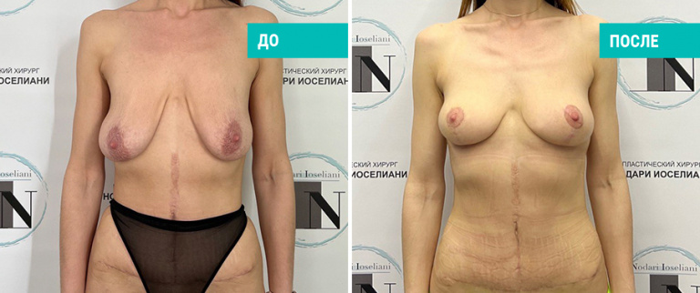 Фото до и после подтяжки груди. Пациентка Н. Б. Иоселиани