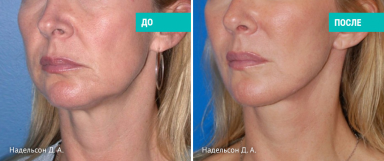 До и после нитевого лифтинга. Пластический хирург Д. А. Надельсон
