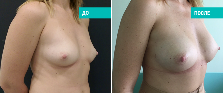 До и после липофилинга. Пластический хирург Е. А. Лонская