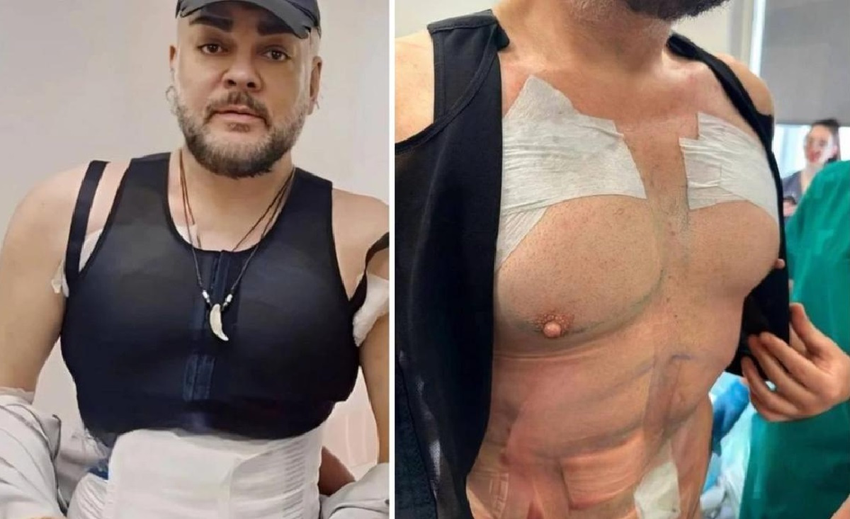 Филипп Киркоров после липомоделирования