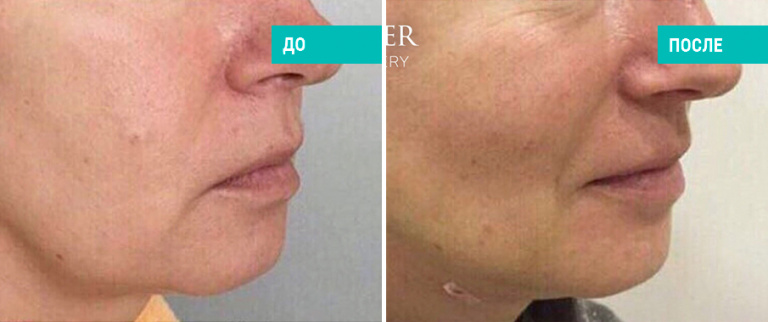 До и после нитевого лифтинга. Пластический хирург Л. Н. Гауэр