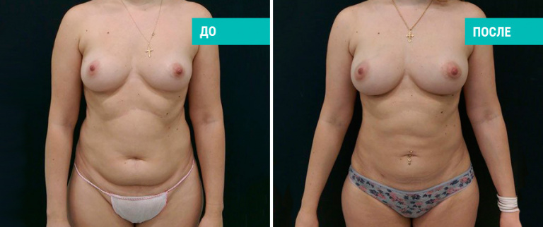 До и после липофилинга. Пластический хирург В. А. Зленко