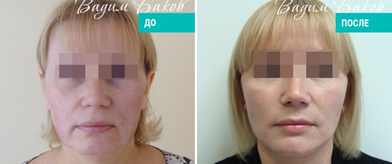 До и после нитевого лифтинга. Пластический хирург В. С. Баков