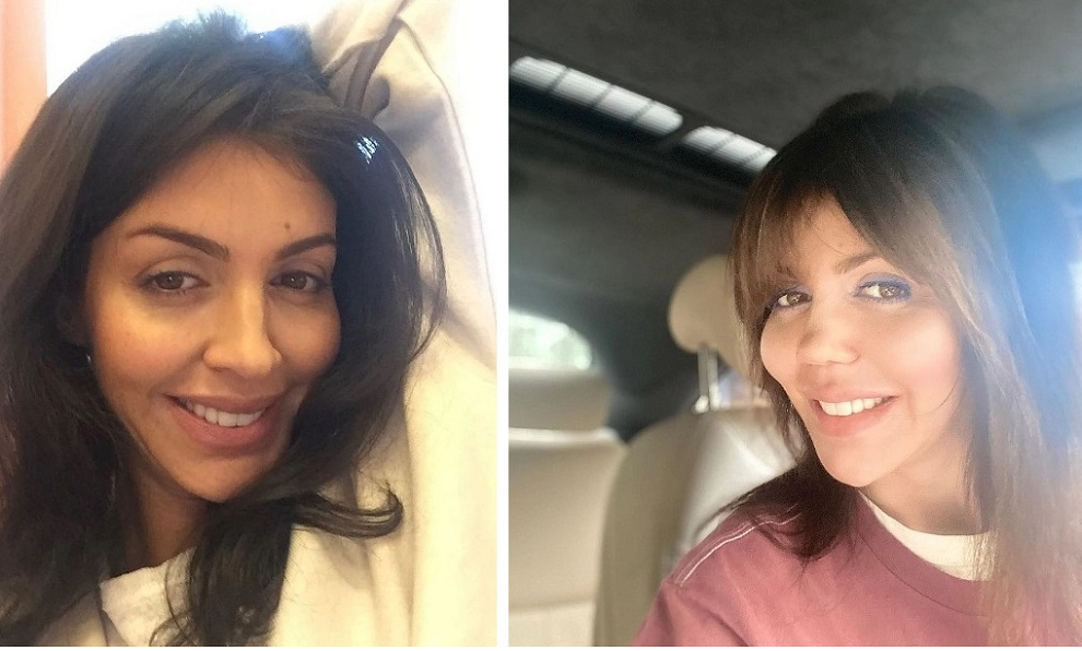 До и после ринопластики