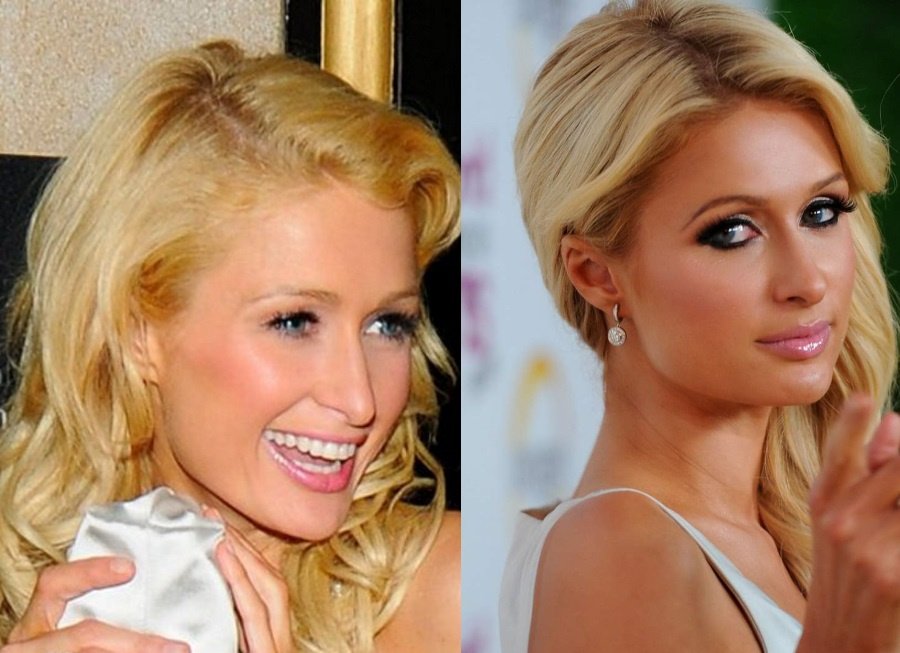 До и после ринопластики