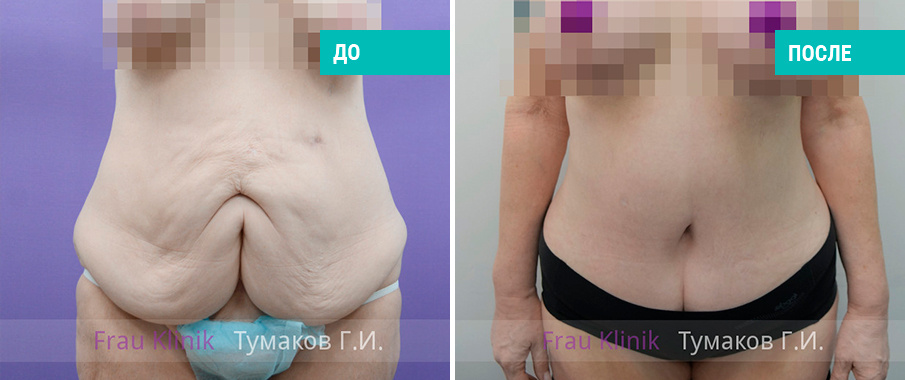 До и после пластики живота. Пластический хирург Г. И. Тумаков
