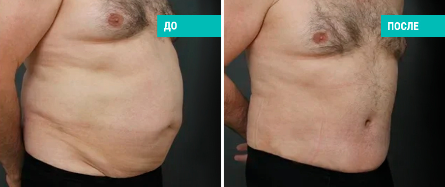 До и после пластики живота. Пластический хирург В. Э. Кобазев