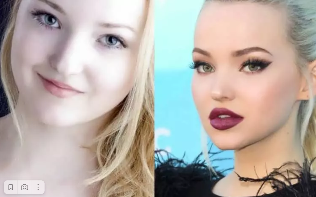 До и после подтяжки лица