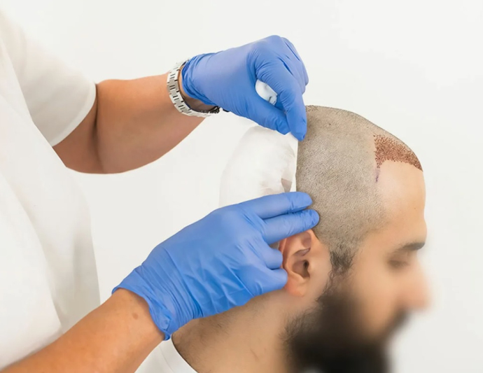 Пересадка волос