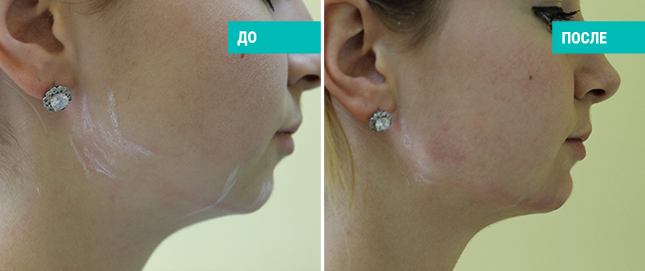 До и после контурной пластики скул и подбородка. Пластический хирург Аль-Юсеф Амжад