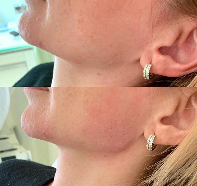 Процедура выполнена специалистами клиники омоложения Левона Чахояна