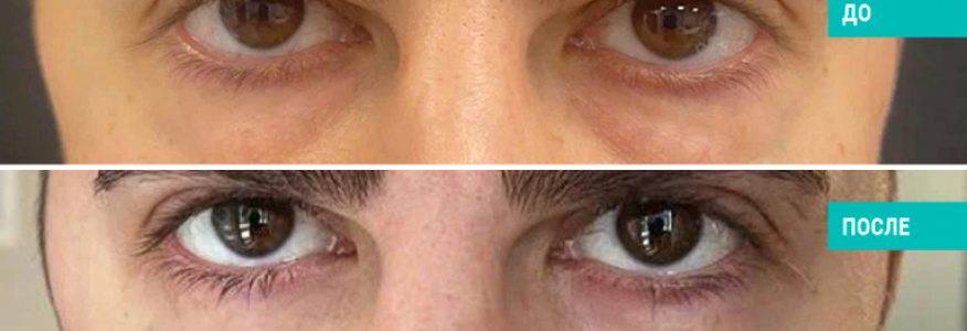 Блефаропластика