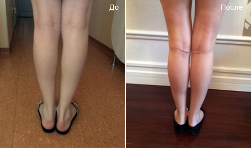 Расположение рубцов после круропластики. Пластический хирург Д. В. Крысин