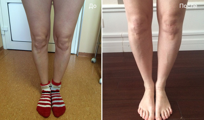 До и после круропластики. Пластический хирург Д. В. Крысин