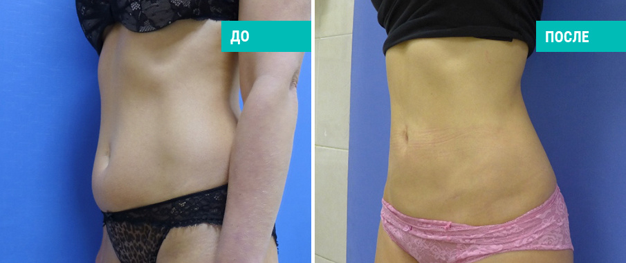 Липосакция живота. Пластический хирург А. А. Михайлов