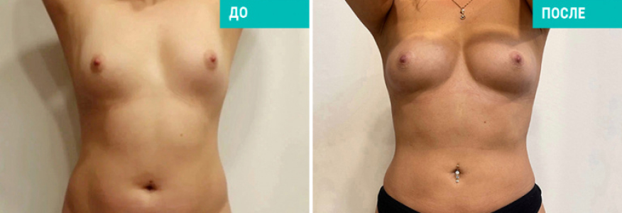 Липофилинг