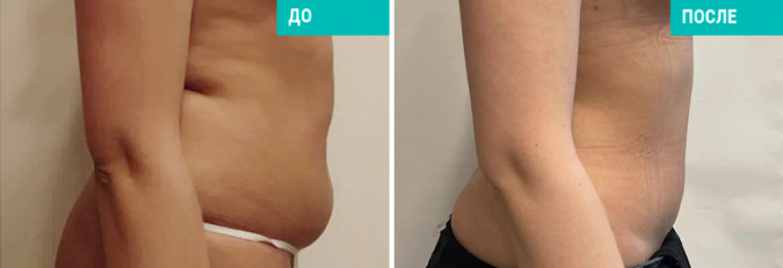 Липофилинг