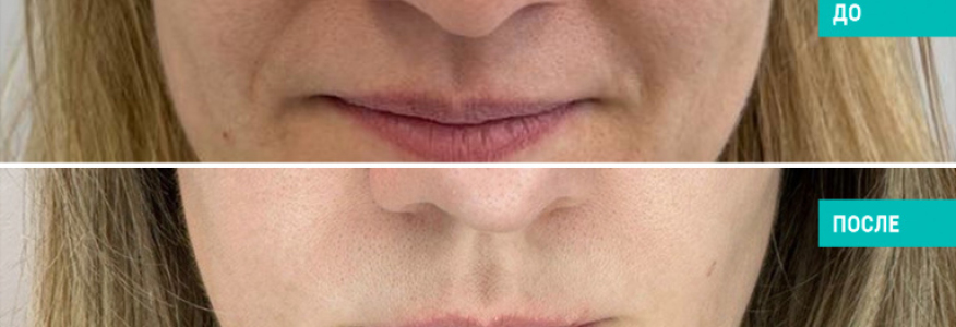 Липофилинг