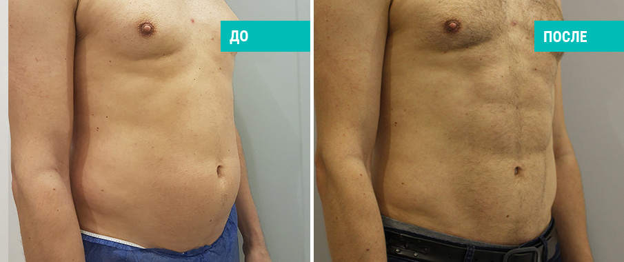Vaser-липосакция живота. Пластический хирург В. А. Зленко