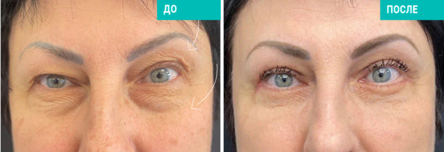 Блефаропластика