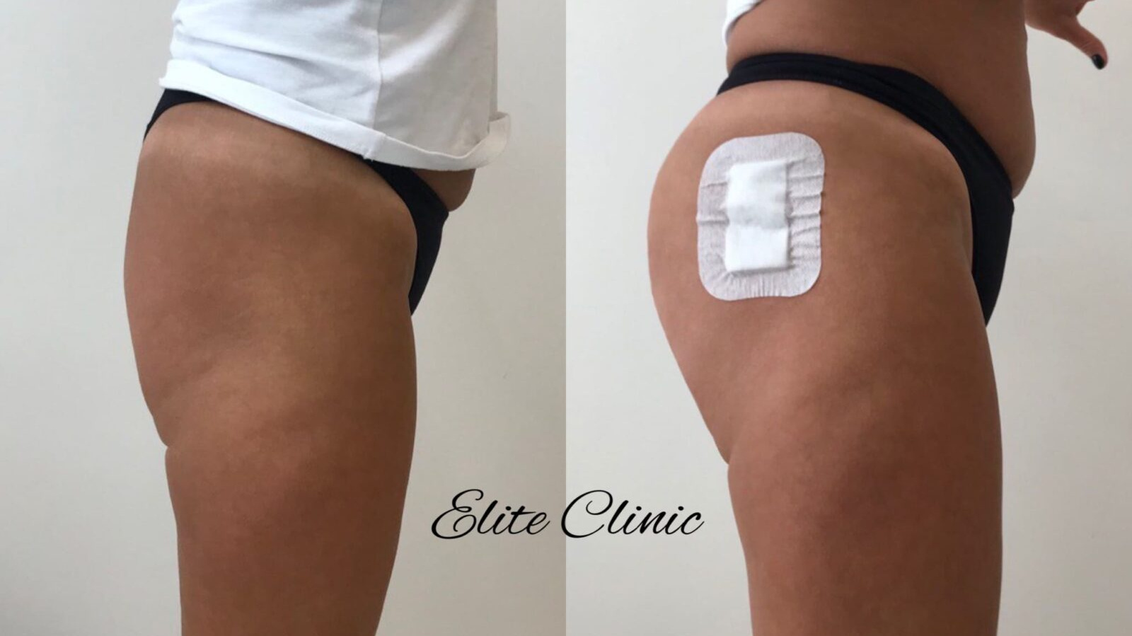 Увеличение ягодиц гиалуроновой кислотой. Процедура выполнена специалистами Elite Clinic