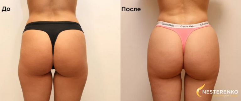 До и после липофилинга ягодиц. пластический хирург М. Л. Нестеренко