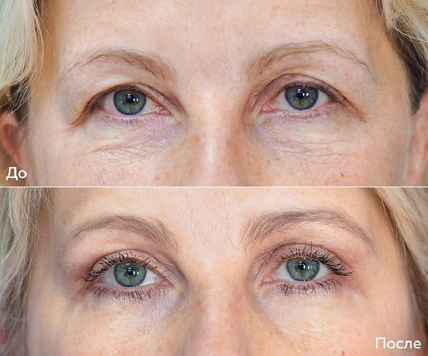 Пациентка А. Н. Ковынцева до и после пластики век