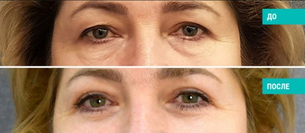 До и после круговой блефаропластики. Пластический хирург В. В. Наумов